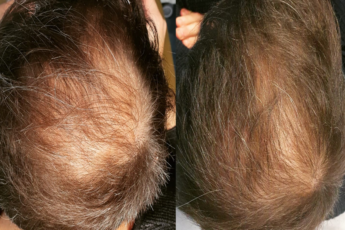 Trattamento Tricopat per l'alopecia in Casa di Cura Piacenza
